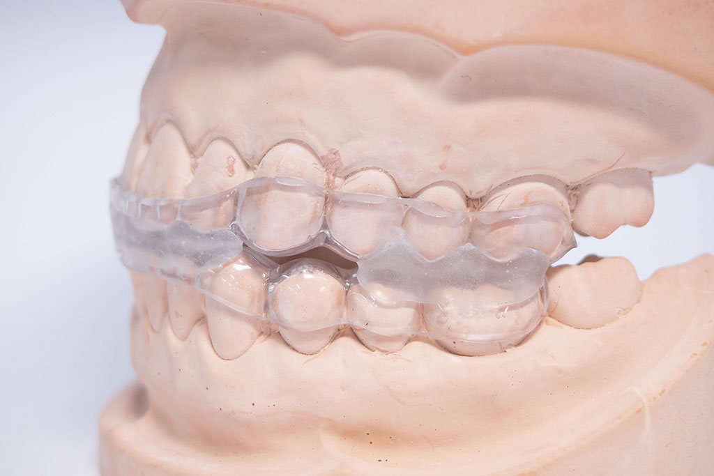 マウスピース治療